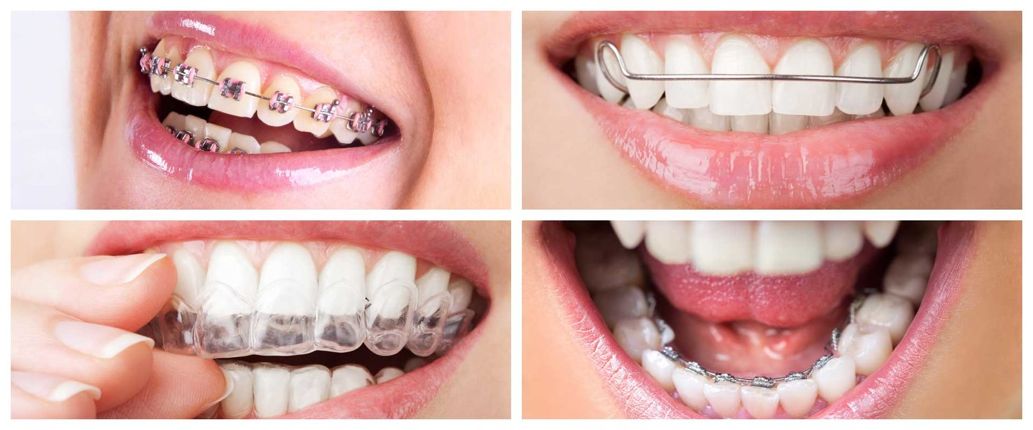 Information about the different types of dental braces