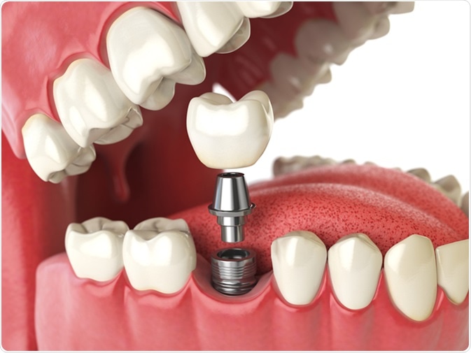 Dental implants and their uses